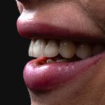 Abcesul dentar: Simptome, cauze și tratamente
