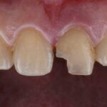 Trauma Dentară: Ce Implicații Are Asupra Sănătății Viitoare?