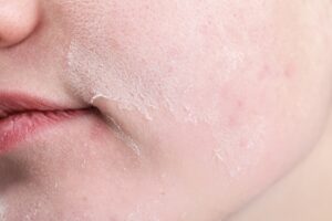 Woman,With,Dry,Skin,On,Face,,Closeup
