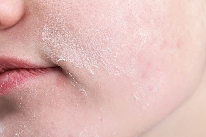 Woman,With,Dry,Skin,On,Face,,Closeup